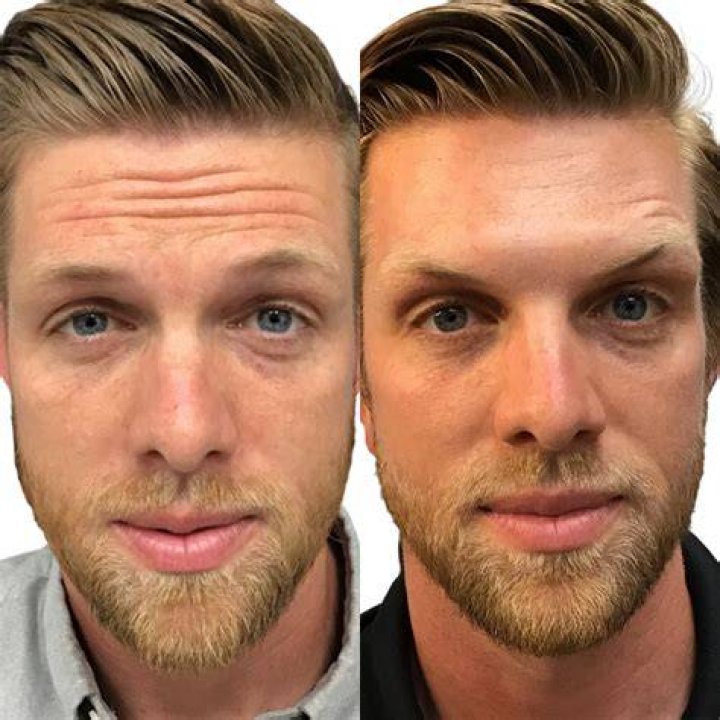 botox for men