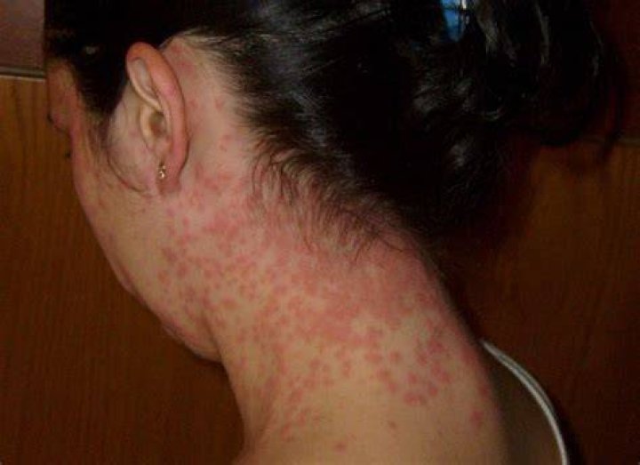 Can Anxiety Cause Red Blotches on Your Skin?