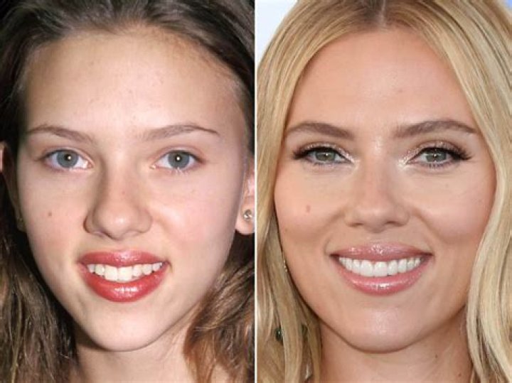 Celebrities with veneers