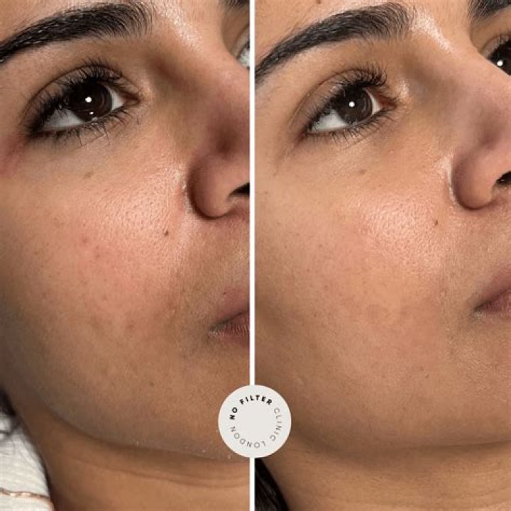 Clear and Brilliant Laser