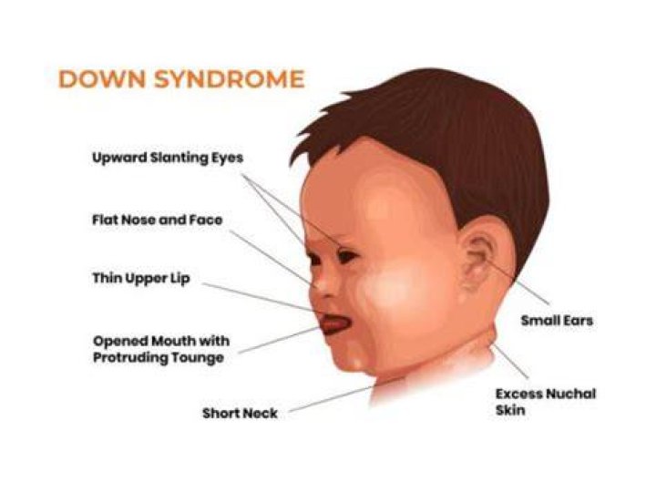 Does Baby Crew Have Down Syndrome?