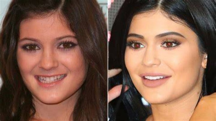 Does Kylie Jenner Have Veneers?