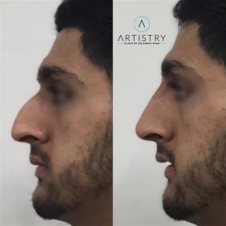 Greek-shaped nose Greek-shaped nose