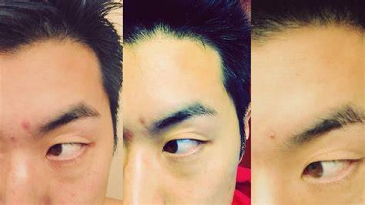 How To Put Makeup on a Popped Pimple