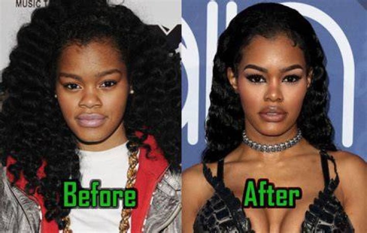 Teyana Taylor plastic surgery (2) Celebrity plastic surgery online